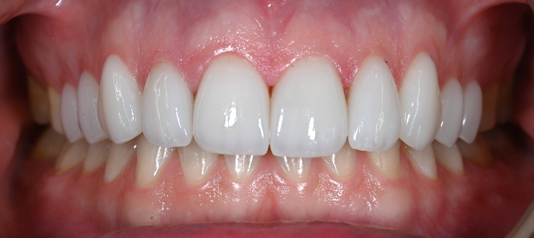 Second dental photograph